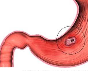 Úlceras – causas, sintomas e tratamentos