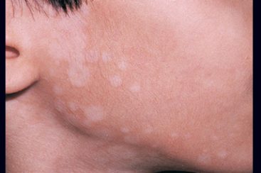 Vitiligo – causas, sintomas e tratamentos