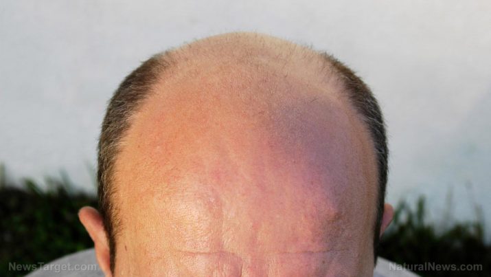 Alopecia – causas, efeitos colaterais e tratamentos