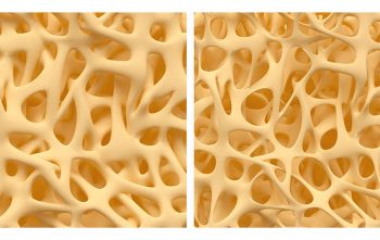 Bone spongy structure close-ups, normal and with osteoporosis