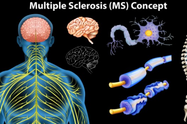 Tratamento de esclerose múltipla